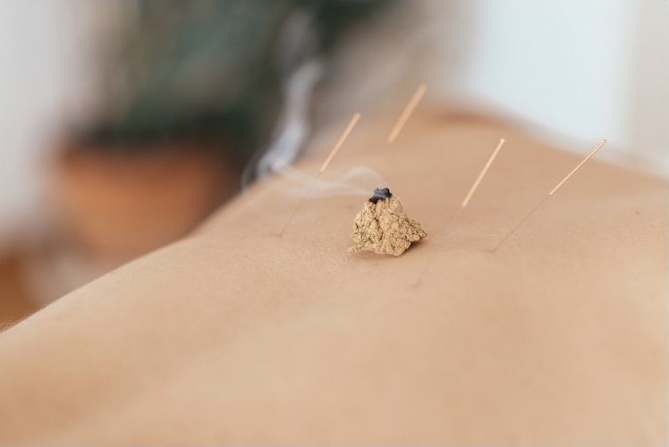 Moxibustion treatment is shown by creating small cones of dried Chinese mugwort on top of the skin.